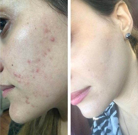 Antes e depois Kit Vitamina C - foto 1