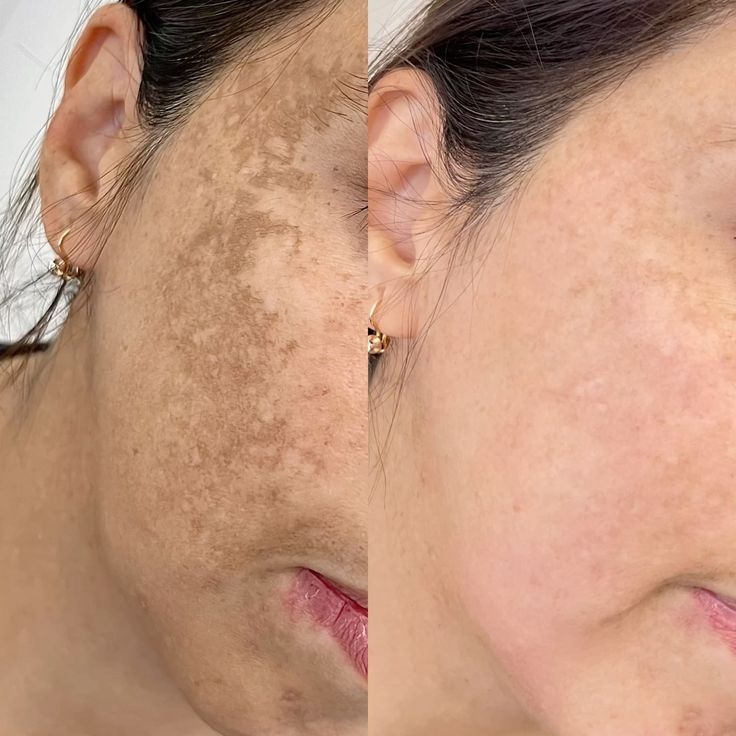 Antes e depois Kit Vitamina C - foto 5